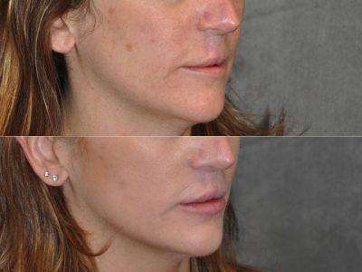 Modified Upper Lip Lift to revise cleft lip scarring - Right Side