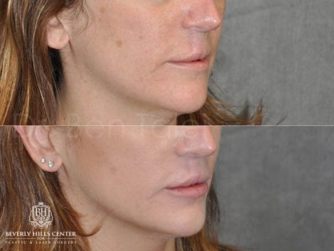 Modified Upper Lip Lift to revise cleft lip scarring - Right Side