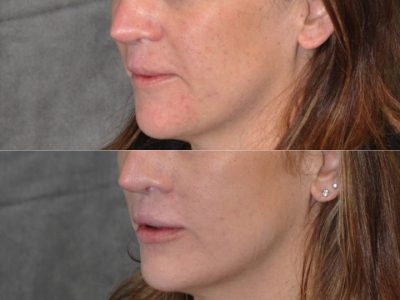 Modified Upper Lip Lift to revise cleft lip scarring - Left Side