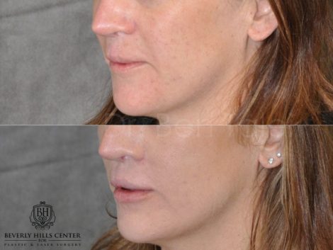 Modified Upper Lip Lift to revise cleft lip scarring - Left Side
