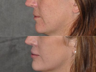 Modified Upper Lip Lift to revise cleft lip scarring - Left Side