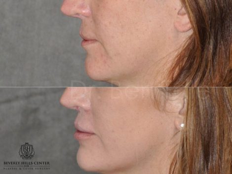 Modified Upper Lip Lift to revise cleft lip scarring - Left Side