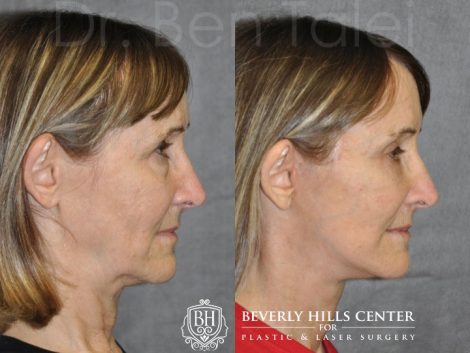 Deep Plane Mini Lift - Right Side