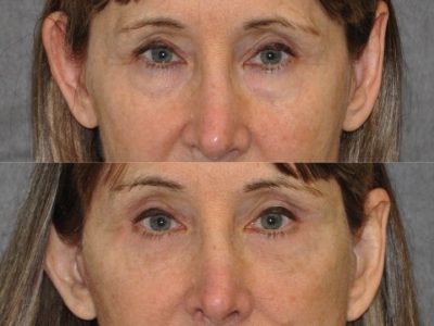 Upper and Lower Eyelid Lift using Fat Transposition - Front