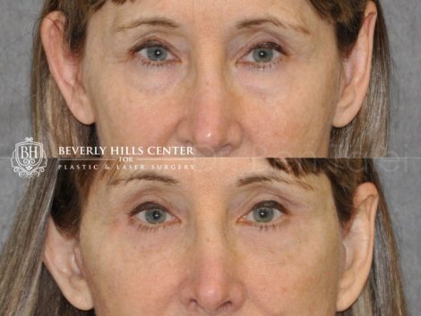Upper and Lower Eyelid Lift using Fat Transposition - Front
