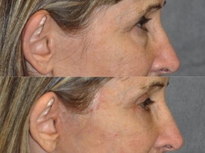 Upper and Lower Eyelid Lift using Fat Transposition - Right Side