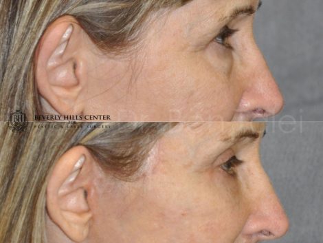 Upper and Lower Eyelid Lift using Fat Transposition - Right Side