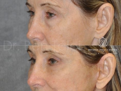 Upper and Lower Eyelid Lift using Fat Transposition - Left Side