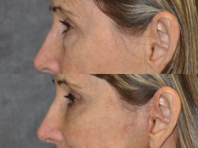 Upper and Lower Eyelid Lift using Fat Transposition - Left Side