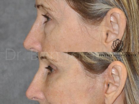 Upper and Lower Eyelid Lift using Fat Transposition - Left Side