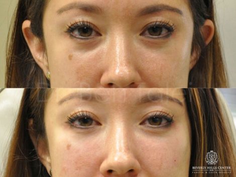 Beverly Hills Center Female Patient Before and After Non-surgical Eye Rejuvenation