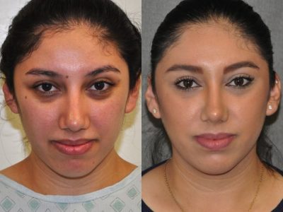 Minimally Invasive / Closed Rhinoplasty & Nostril Lightening - Front