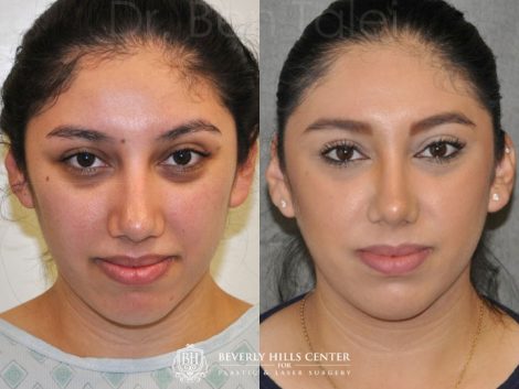 Minimally Invasive / Closed Rhinoplasty & Nostril Lightening - Front