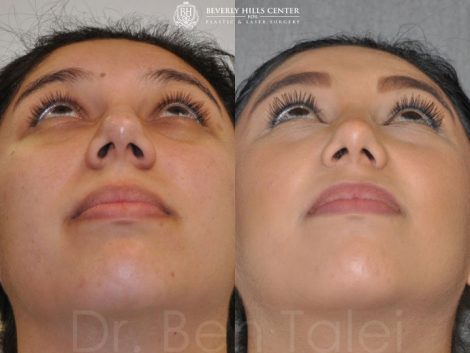Minimally Invasive / Closed Rhinoplasty & Nostril Lightening - Base