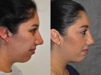 Minimally Invasive / Closed Rhinoplasty & Nostril Lightening - Right Side