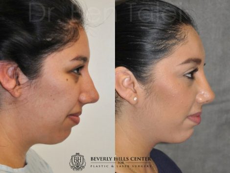 Minimally Invasive / Closed Rhinoplasty & Nostril Lightening - Right Side