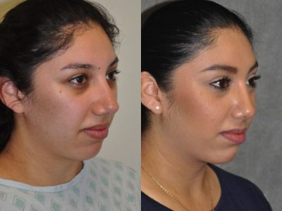Minimally Invasive / Closed Rhinoplasty & Nostril Lightening - Right Side