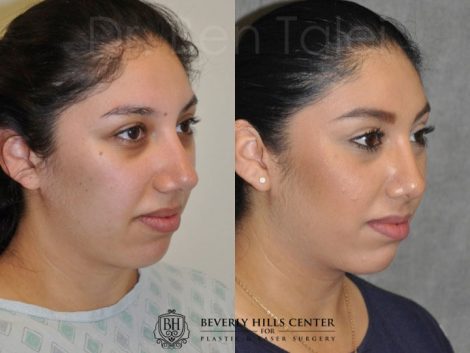 Minimally Invasive / Closed Rhinoplasty & Nostril Lightening - Right Side