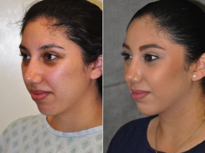 Minimally Invasive / Closed Rhinoplasty & Nostril Lightening - Left Side