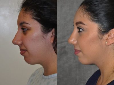 Minimally Invasive / Closed Rhinoplasty & Nostril Lightening - Left Side