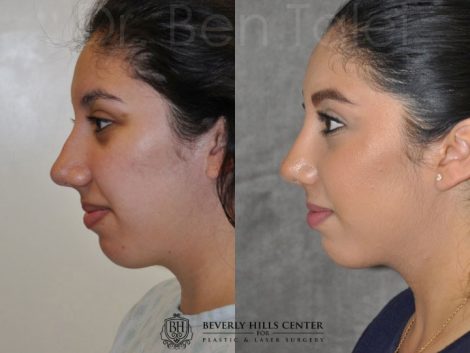Minimally Invasive / Closed Rhinoplasty & Nostril Lightening - Left Side