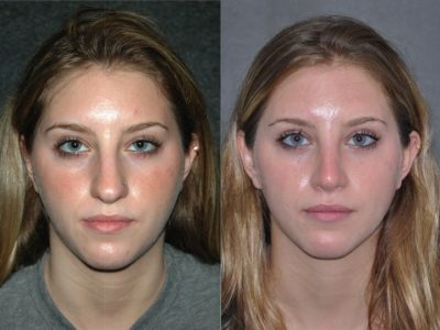 Minimally Invasive (Closed) Rhinoplasty - Front