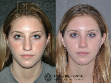 Minimally Invasive (Closed) Rhinoplasty - Front