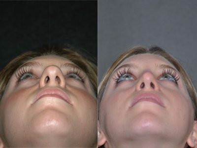 Minimally Invasive (Closed) Rhinoplasty - Base