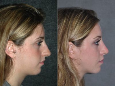 Minimally Invasive (Closed) Rhinoplasty - Right Side