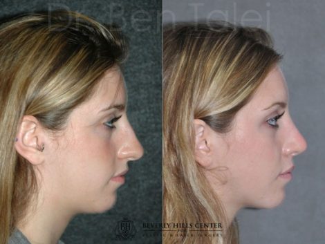Minimally Invasive (Closed) Rhinoplasty - Right Side