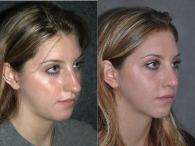 Minimally Invasive (Closed) Rhinoplasty - Right Side