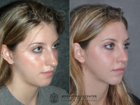 Minimally Invasive (Closed) Rhinoplasty - Right Side
