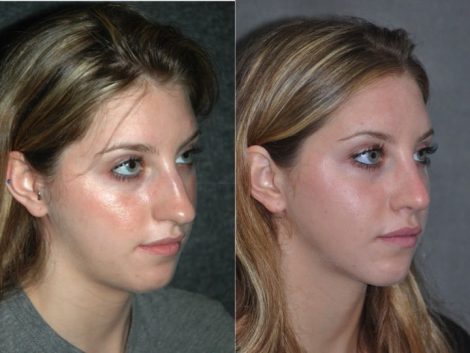 Minimally Invasive (Closed) Rhinoplasty - Right Side