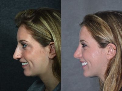 Minimally Invasive (Closed) Rhinoplasty - Left Side