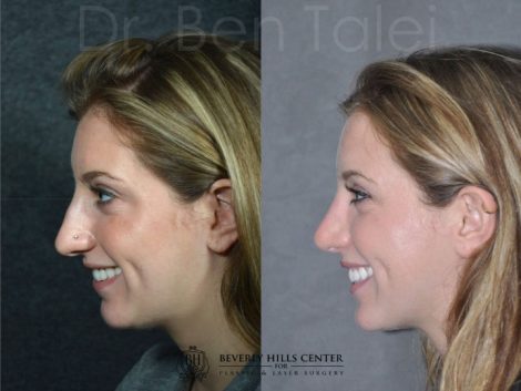 Minimally Invasive (Closed) Rhinoplasty - Left Side