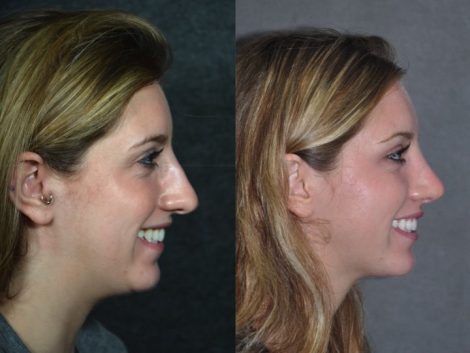 Minimally Invasive (Closed) Rhinoplasty - Right Side