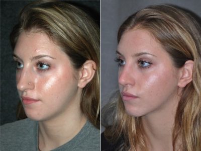 Minimally Invasive (Closed) Rhinoplasty - Left Side