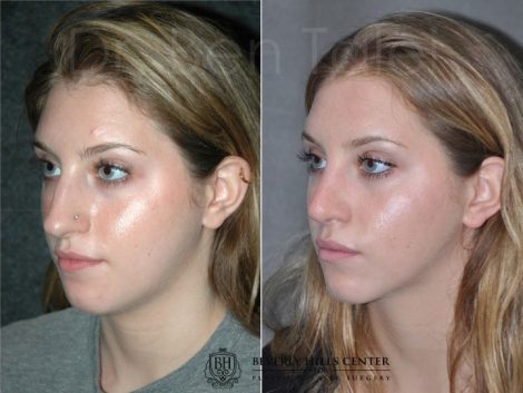 Minimally Invasive (Closed) Rhinoplasty - Left Side