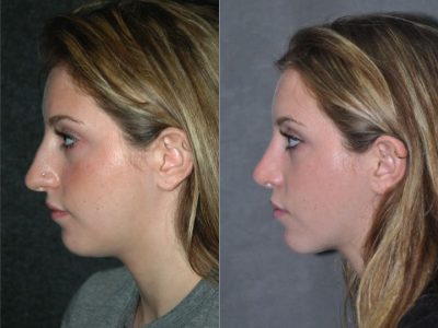 Minimally Invasive (Closed) Rhinoplasty - Left Side