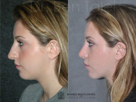 Minimally Invasive (Closed) Rhinoplasty - Left Side