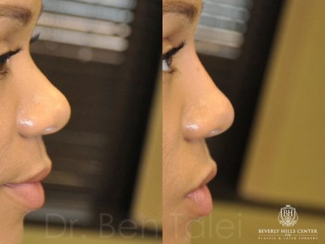 Non Surgical Rhinoplasty / Liquid NoseJob