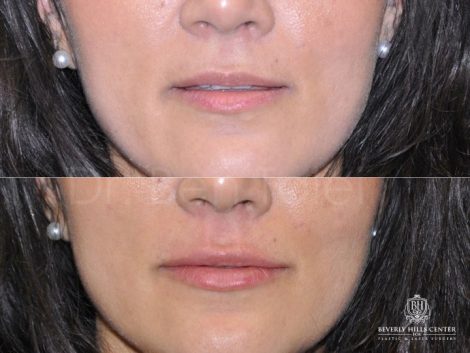 Beverly Hills Center Female Patient Before and After Lip Injection Procedure