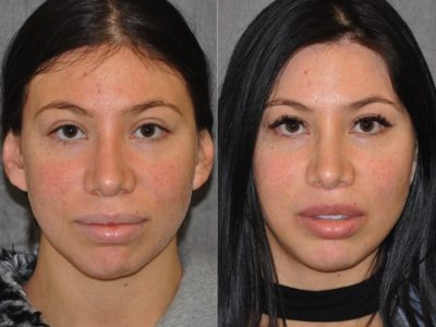 Modified Upper Lip Lift – Front
