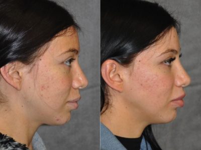 Modified Upper Lip Lift – Right Side