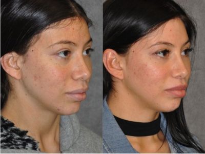 Modified Upper Lip Lift – Right Side