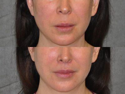Modified Upper Lip Lift – Front