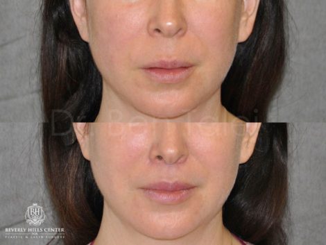 Modified Upper Lip Lift - Front