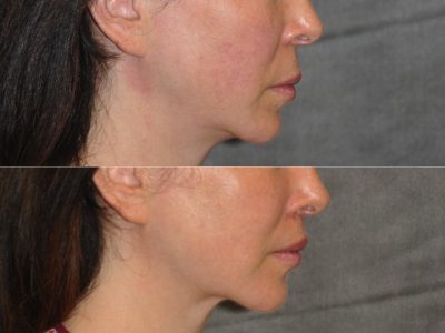 Modified Upper Lip Lift – Right Side