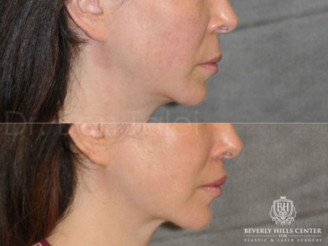 Modified Upper Lip Lift - Right Side