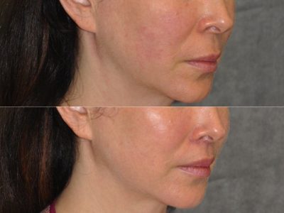 Modified Upper Lip Lift – Right Side